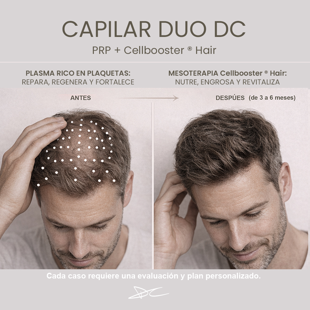 Capilar Boost DC® · PRP + Mesoterapia Capilar - Image 2