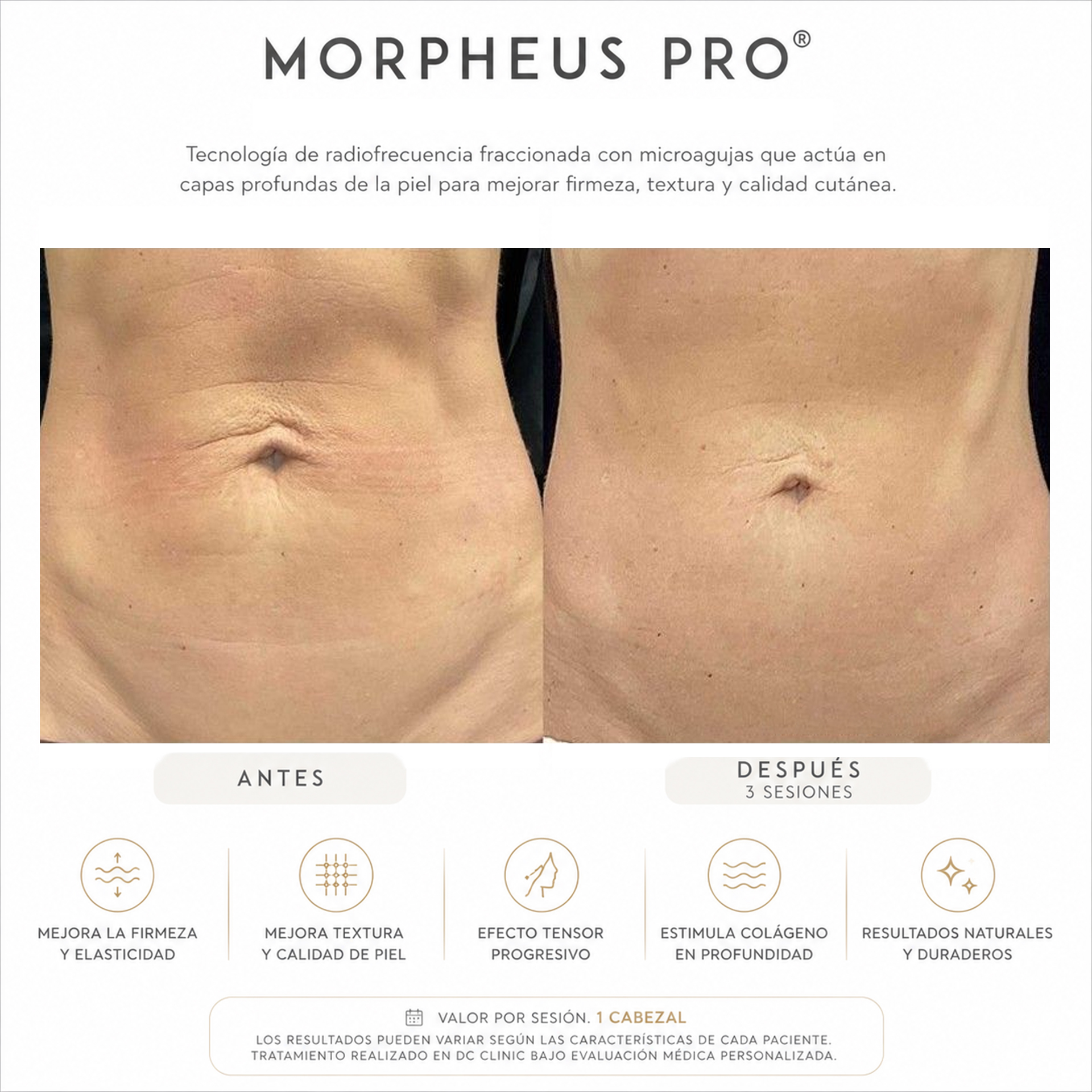 Morpheus PRO® · Radiofrecuencia Fraccionada Corporal - Image 5