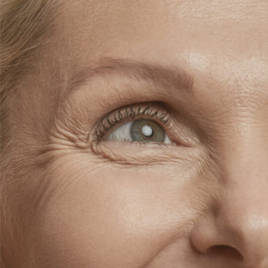 Blefaroplastia